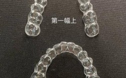 透明贴片矫正效果如何？隐形舒适度够吗？