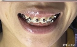 成都省医院矫正牙齿效果如何？价格贵不贵？