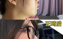 拔8颗牙齿矫正，图片效果真的能变美吗？