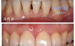 矫正牙齿黑三角是什么？