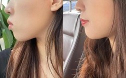 牙齿矫正会导致颧骨下移吗？矫正后颧骨变化的深层原因是什么？