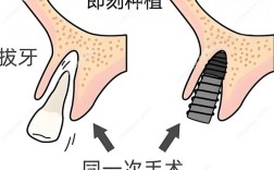 全口即刻种牙需满足哪些条件？适合人群有哪些？