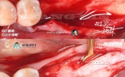 植牙骨粉掉出来了该怎么办？