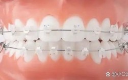 正畸陶瓷托槽彩色标志如何提升正畸精准度与美观度？