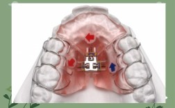 牙齿功能矫正器与传统矫正器功能差异在哪？