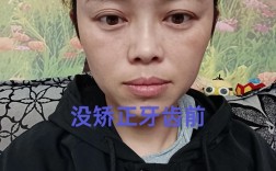 牙齿矫正后露牙龈加重，是矫正方式问题吗？