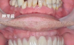 种牙后旁边牙齿会动？原因何在？是否正常？
