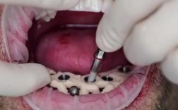 有牙医会自己种牙吗？亲身种牙的牙医多吗？他们为何选择自己动手？