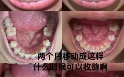 拔牙矫正后牙齿反弹，究竟是什么原因导致的？又该如何有效预防？
