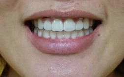 正畸后牙齿出现牙缝，究竟是什么原因造成的？