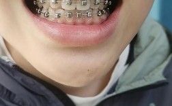 7岁儿童矫正牙齿，现在矫正时机合适吗？