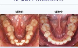 正畸导致牙弓狭窄