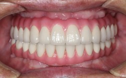 种牙效果怎么样