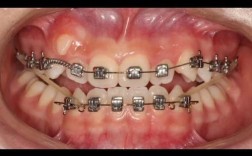 正畸片段弓是什么？它的原理、作用及适用范围具体是怎样的？