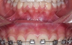 上海牙齿矫正有哪些常见的矫正方式、类型和选择方案？