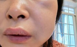 种牙植骨要肿多久