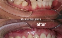 正畸拔三颗牙的原因是什么？案例图片看懂这些治疗关键点