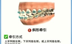 正畸牙齿带皮筋的作用