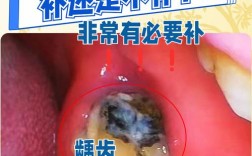 蛀牙对种牙有影响吗