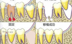自体牙移植手术方法的具体步骤和要点是什么？