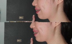 牙齿矫正牙龈外露是什么原因？