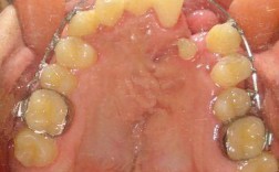 植骨术后全口正畸，何时介入最合适？