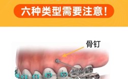 种牙三颗牙打几个钉