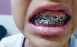 为什么矫正牙齿一个月后就后悔了？