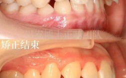 不拔牙的正畸效果图