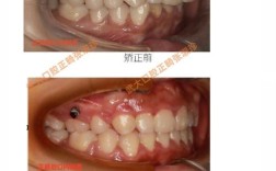 牙齿矫正不对称拔牙