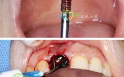 植牙打桩桩体松动