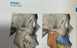 龅牙正畸正颌手术