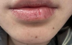 植牙骨后嘴巴干燥是什么原因？该如何有效缓解？