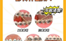 正畸后什么时候戴皮筋？戴多久合适？