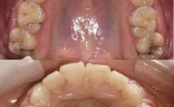 正畸尖牙关系案例中，尖牙III类关系如何矫治？