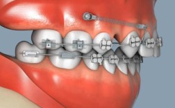 正畸支抗钉转动方向有何讲究？