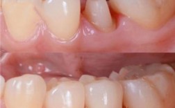 冠修复后正畸治疗