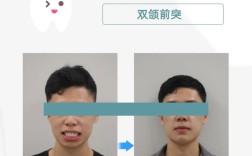 偏颌是正畸还是手术