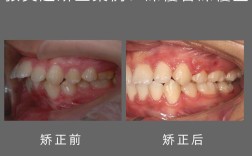 牙齿矫正抬高后牙，有何作用与注意事项？