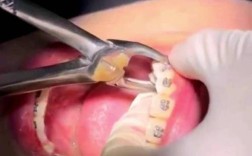 正畸时，横向阻生齿是否必须拔除？不拔会影响矫正效果吗？