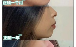 正畸后脸型会变瘦吗