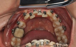 正畸带分牙器带环