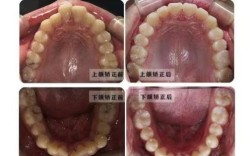 正畸哪个阶段牙齿变化最明显？