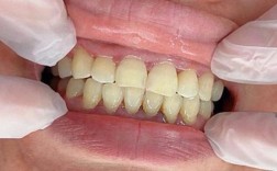 正畸牙根部位偏黄