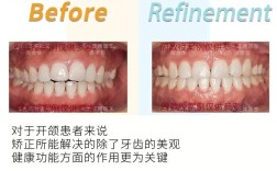 种牙如何精准调咬合？关键步骤有哪些？