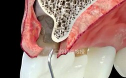 上海九院牙周科植骨术效果如何？适合哪些患者？