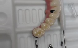 深圳即种半口种植牙，即刻种植半口牙的优势与效果如何？