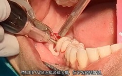 智齿拔除种牙