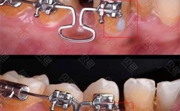 正畸末端回弯程度