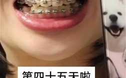 正畸完 后 牙缝